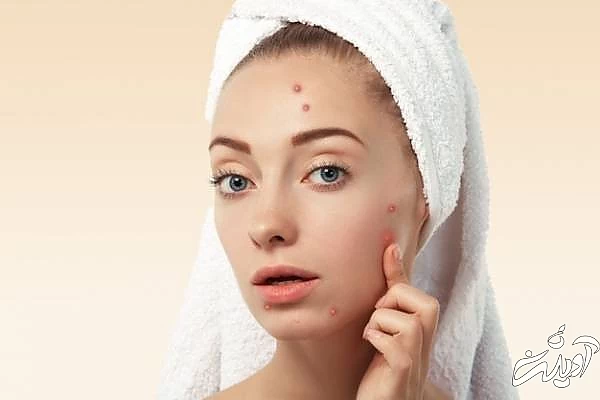 درمان جوش از خواص چای با لیمو ترش درمان جوش